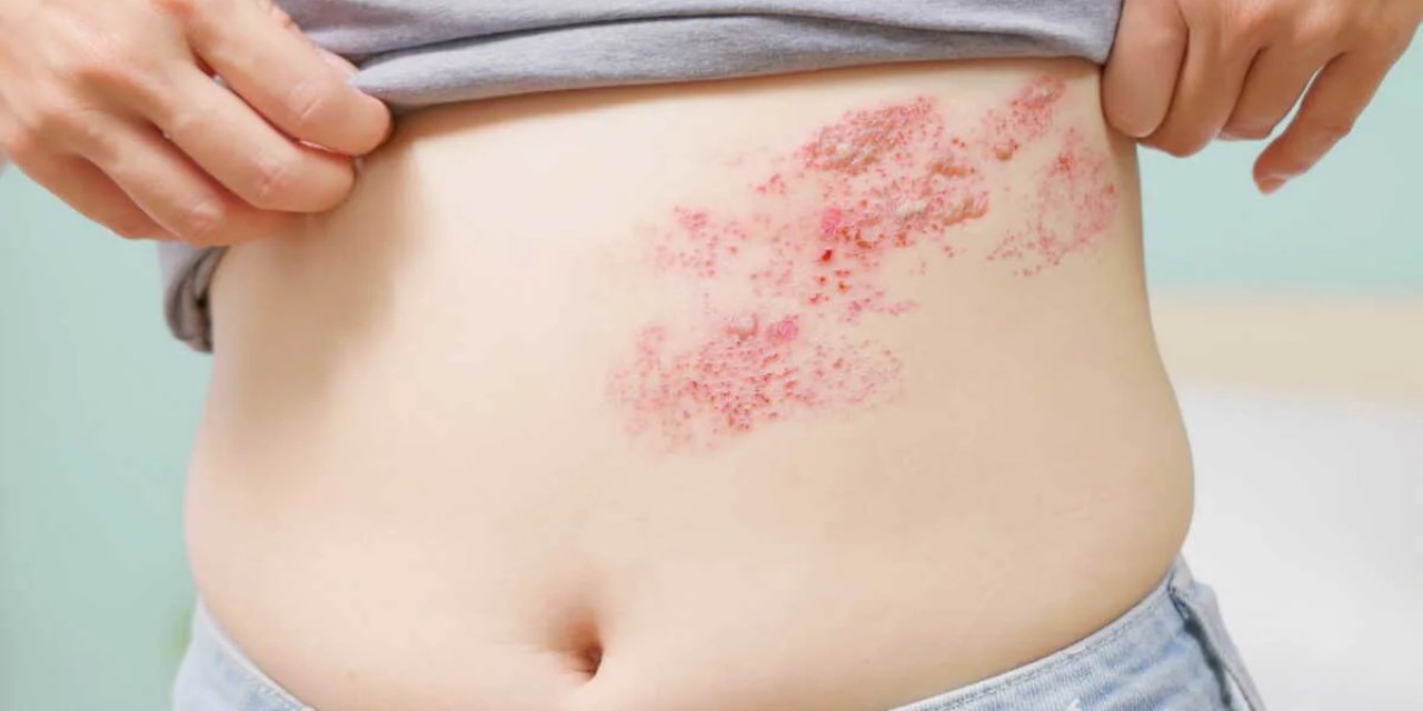 Zona Görülme Riski 50 Yaşından Sonra Artıyor