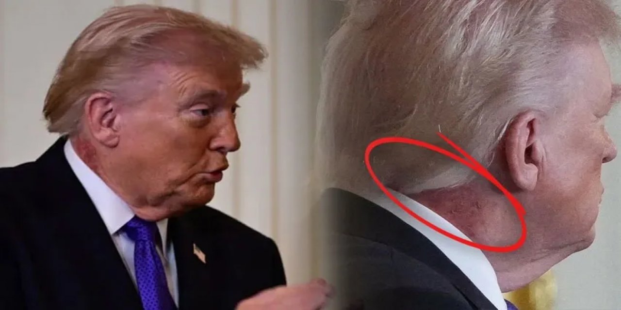 Daha Önce Ellerinde Görülmüştü: Trump'ın Boynundaki Morluklar Gündem Oldu!