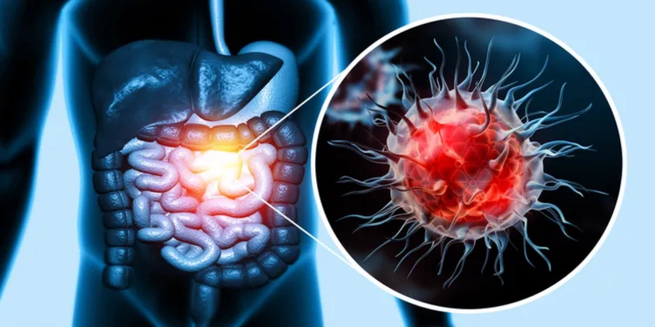 Sessiz İlerliyor: Kolon Kanserinin En Yaygın Belirtileri Açıklandı