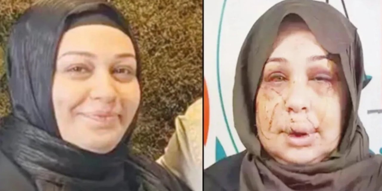 Boşanmak İsteyen Eşinin Yüzünü Kesen Polis Memuru Yasin Çakmak İçin 15 Yıl Hapis İstemi