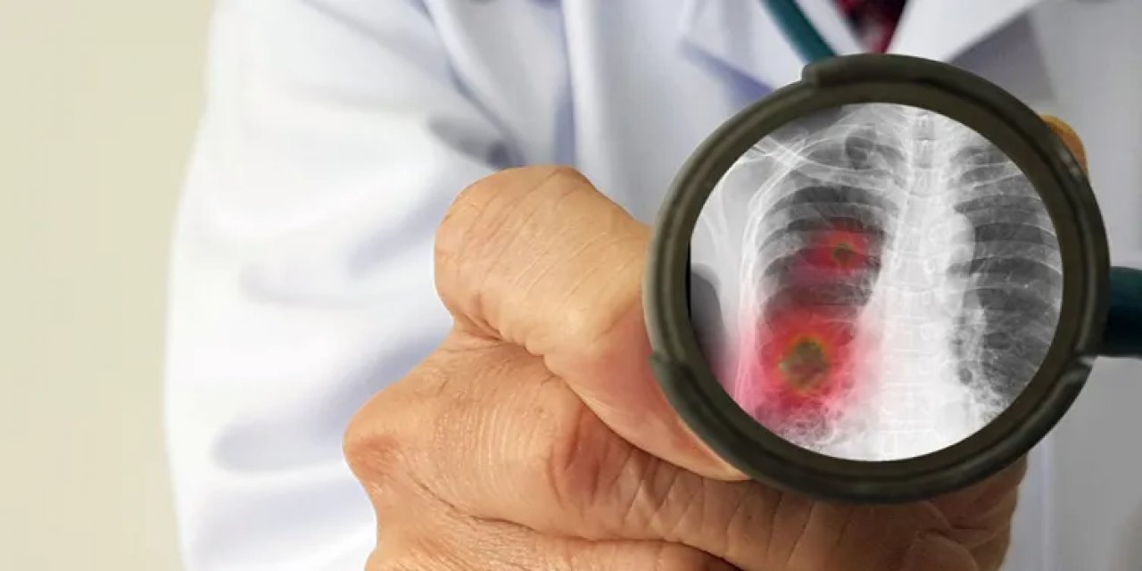 Her 100 Kişiden 1’inde Görülüyor! Zatürre Belirtilerini Hafife Almayın