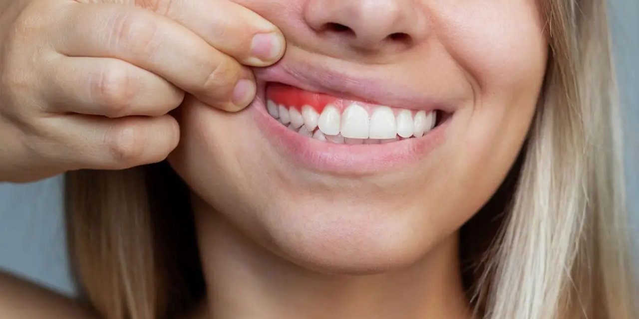 Diş Eti Kanaması Sistemik Hastalıkların Habercisi Olabilir