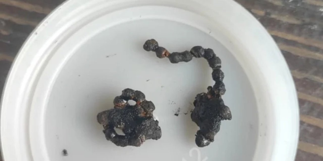 Rize'de 5 Yaşındaki Çocuğun Burnundan Tırnak Makası Zinciri Çıktı