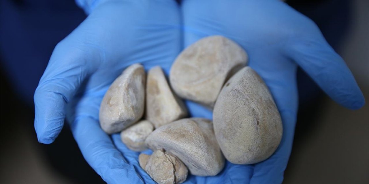 İdrar Kanalı Ve Mesanesinden Yarım Kilogram Ağırlığında 6 Taş Çıkarıldı