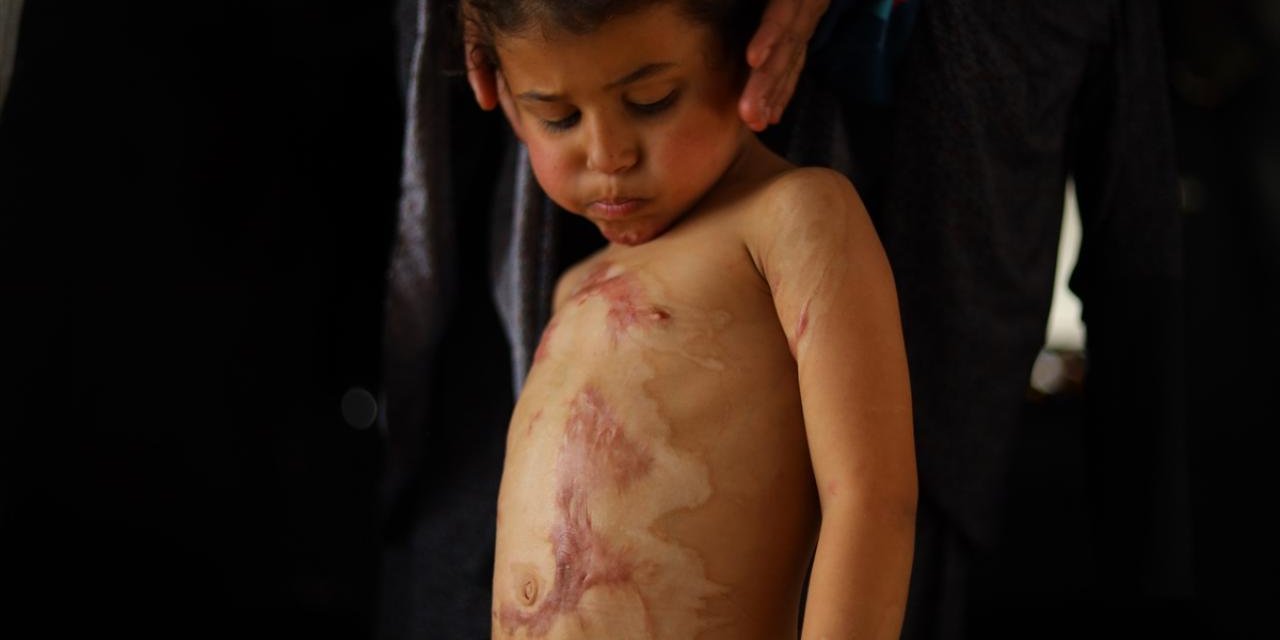 Katil İsrail'in Kısıtlamaları Nedeniyle Gazze'de Yanık Hastaları İçin Tıbbi Malzemeler Tükenmek Üzere