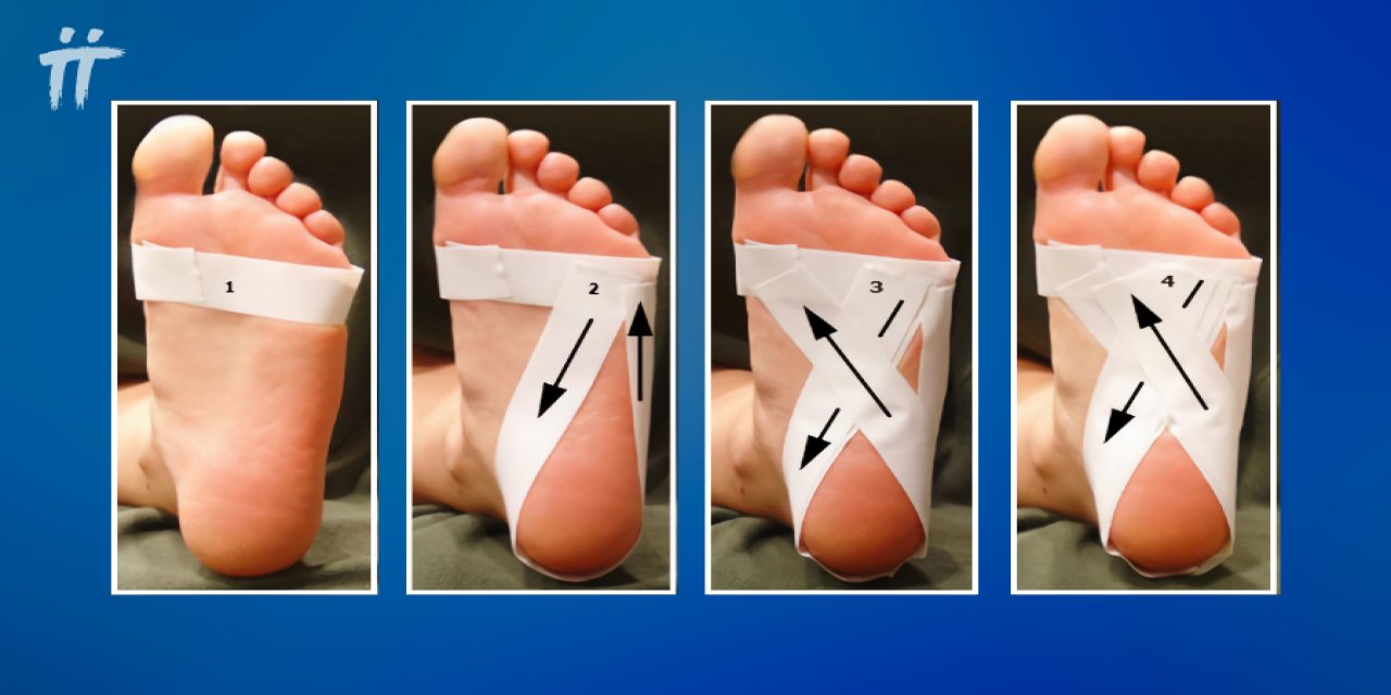 Kronik Topuk Dikeni Tedavisinde Anjiyografik Yöntem Ağrıyı Azaltıyor