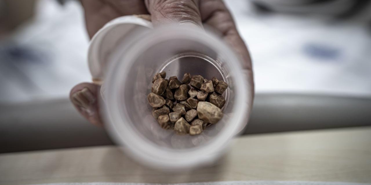 İdrar Kanalından 51 Taş Çıkarıldı