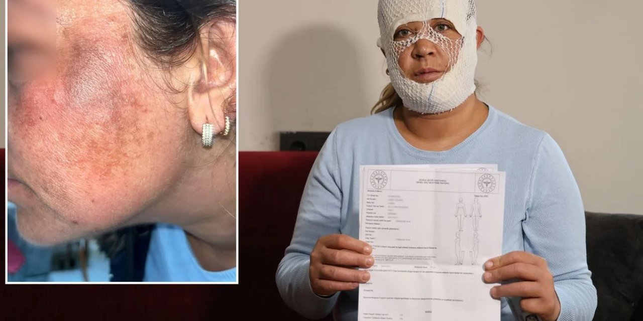 Bir Güzellik Salonu Mağduru Daha; "Prenses Cilt Bakımı Yüzümü Yaktı"  İddiası