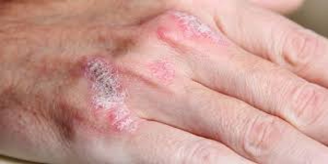 Ciltteki Kaşıntı Ve Kuruluk, Hastalıkların İlk Sinyali Olabilir
