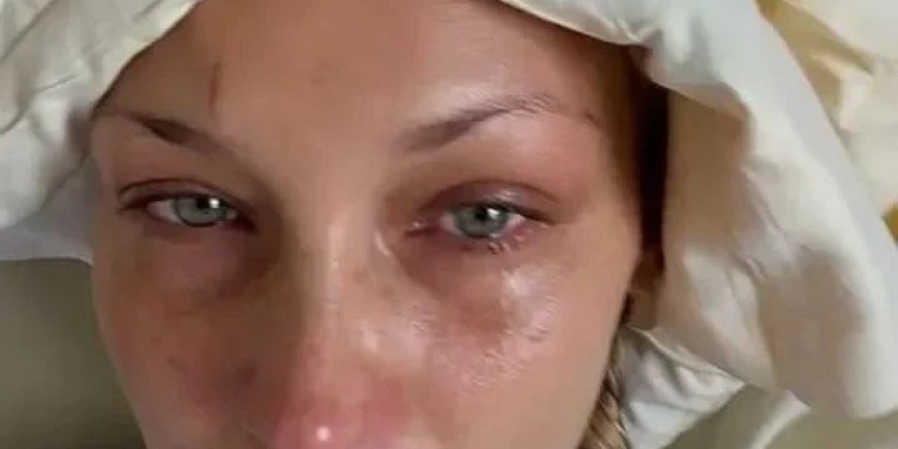 Bella Hadid’den Kötü Haber! Lyme Hastalığıyla Mücadele Ediyordu: Gözyaşlarına Hakim Olamadı