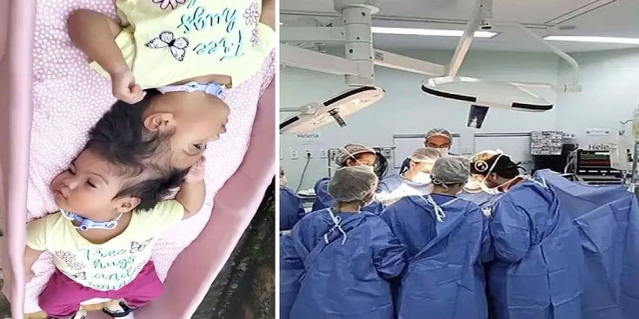 Yapışık İkizlerden Acı Haber: Kalpleri 14 Dakika Arayla Durdu