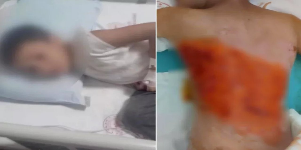 12 Yaşındaki Çocuğu Diri Diri Yaktılar! Sonrası Daha Da Korkunç