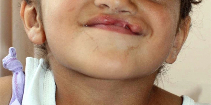 Gebelikte İlaç Kullanımında 'Dudak Ve Damak Yarığı' Riski