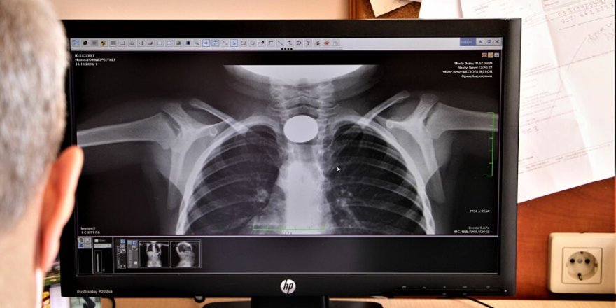 Çocukların midesinden çıkan yabancı cisimler şaşırttı: Madeni para, misket, toplu iğne