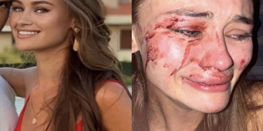 Dünyaca ünlü top model Çeşme'de darp edildi