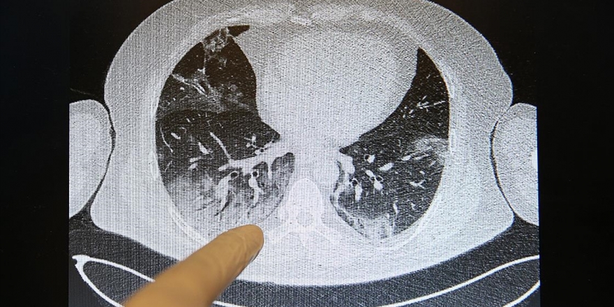 Kovid-19'un Akciğerlere Verdiği Zarar Tomografi Görüntülerine Yansıyor