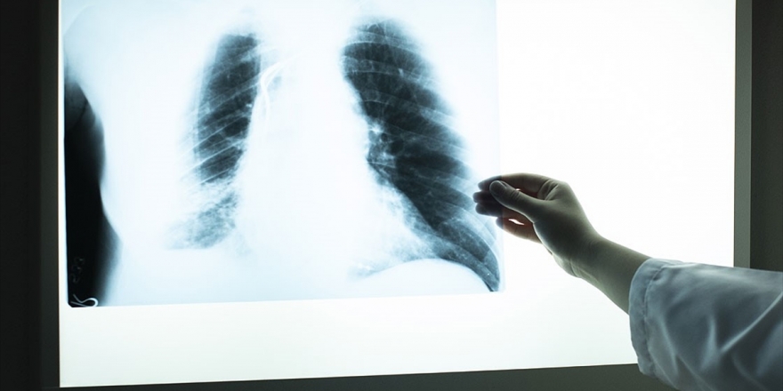 Koah Hastalarında Kovid-19 Daha Ağır Seyrediyor