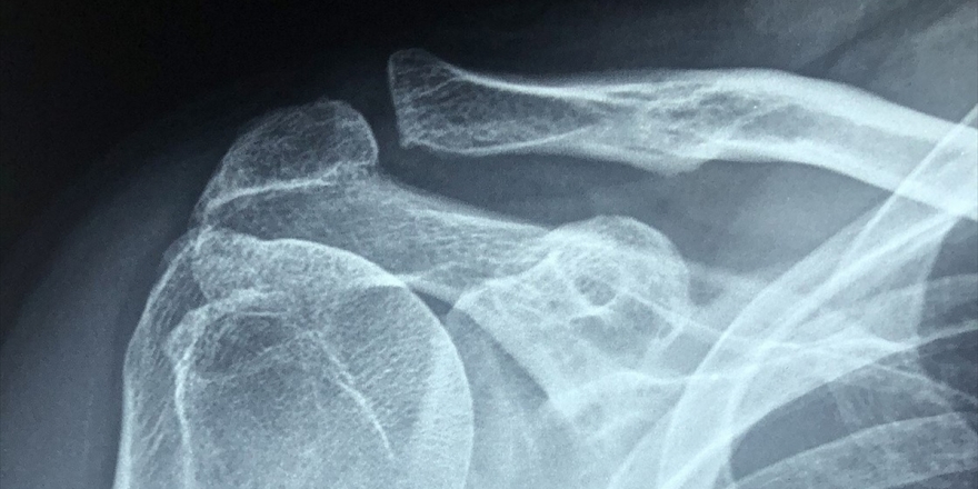 Tekrarlayan Omuz Çıkıklarında Artroskopik Tedavi İle İyileşme Mümkün