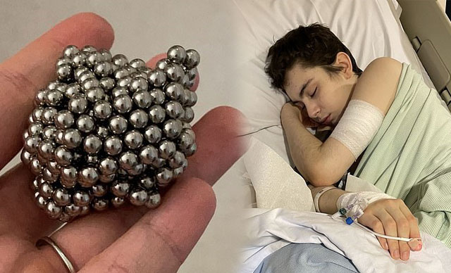 Midesinden 54 tane mıknatıslı bilye çıktı