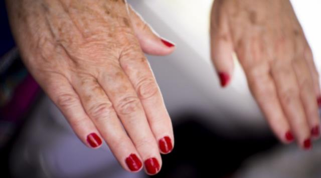 Kelebek hastalığı nedir? Kelebek hastalığı belirtileri nelerdir?