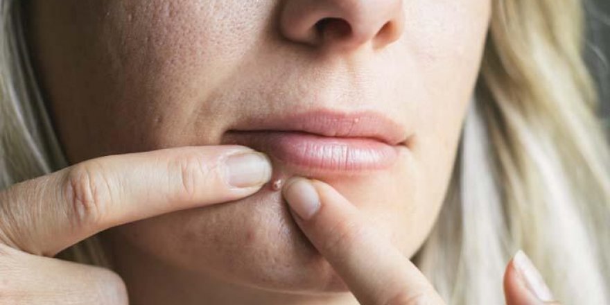 Sivilcelerden kurtulmak için ne yapmalı?