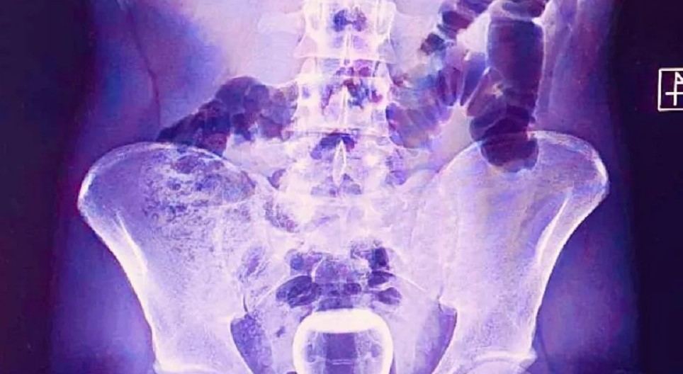 Basur için yapılan hacamat kazaya yol açtı: Çay bardağı ameliyatla çıkarıldı