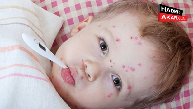 Yaz Aylarında Çocuklarda Görülen Hastalıklar Artıyor