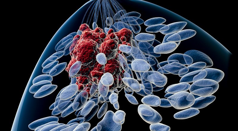 BİLİM İNSANLARI, YÜKSEK KOLESTEROL İLE ÖSTROJEN POZİTİF MEME KANSERİ VE JİNEKOLOJİK KANSERLER ARASINDAKİ BAĞLANTIYI ARAŞTIRDI