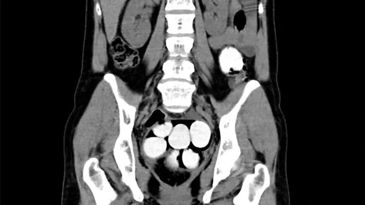 İspanya’dan Çekya’ya gelen yolcunun midesinden yaklaşık 1,5 kilogram kokain çıktı