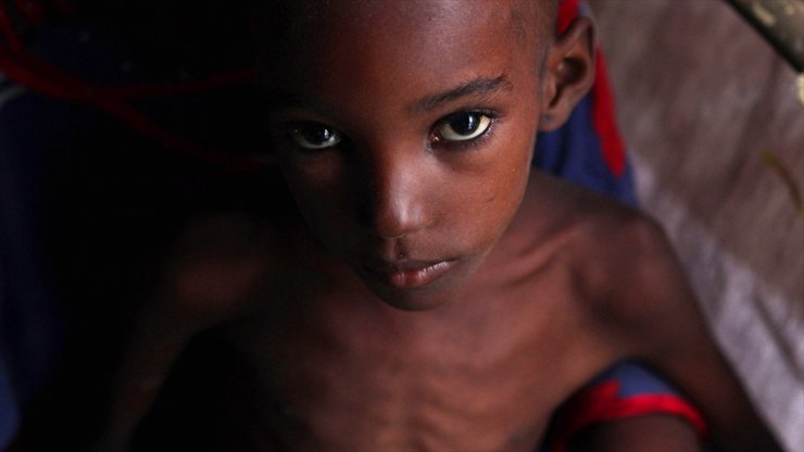 Dünyada Açlığa Bağlı Olarak Her Gün 25 Bin Kişi Yaşamını Yitiriyor