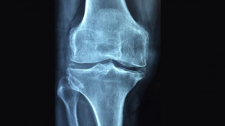 Osteoporoz Tüm Dünyada 3 Kadından Birini Kıskaca Alıyor