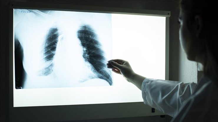 Aşırı Kiloluların Akciğerlerinde Astıma Yol Açan Yağ Dokusu Tespit Edildi